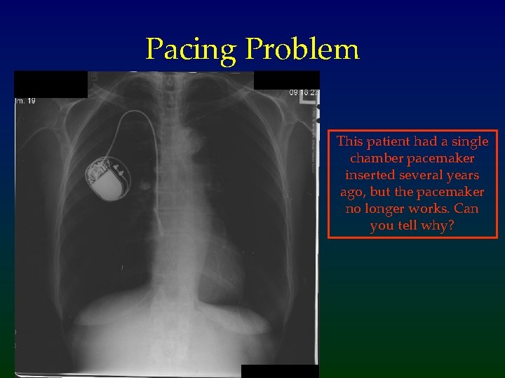 Pacing Problem This patient had a single chamber pacemaker inserted several years ago, but