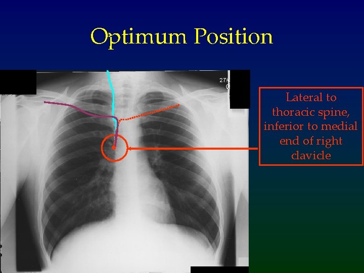 Optimum Position Lateral to thoracic spine, inferior to medial end of right clavicle 