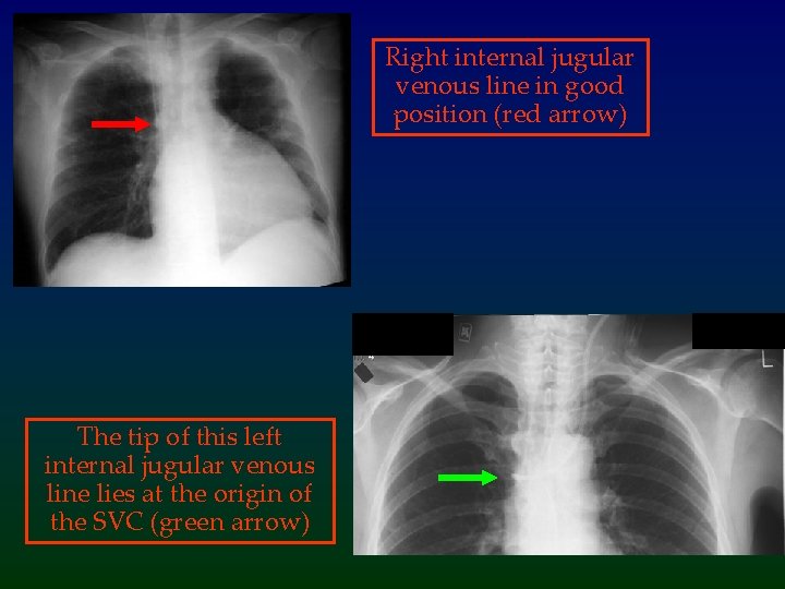 Right internal jugular venous line in good position (red arrow) The tip of this