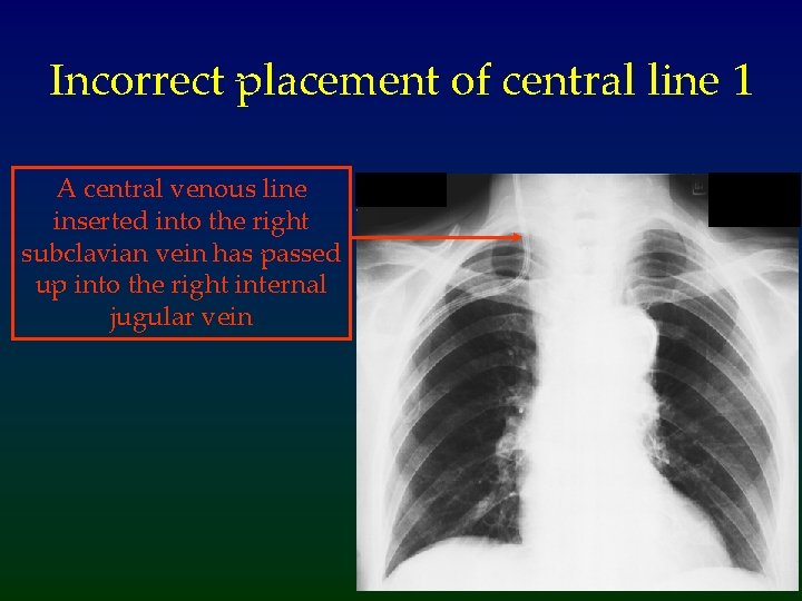 Incorrect placement of central line 1 A central venous line inserted into the right