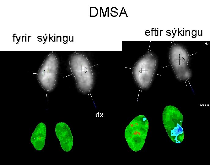 DMSA fyrir sýkingu eftir sýkingu 