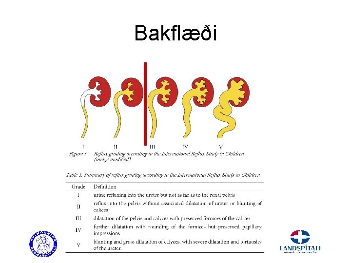 Bakflæði 