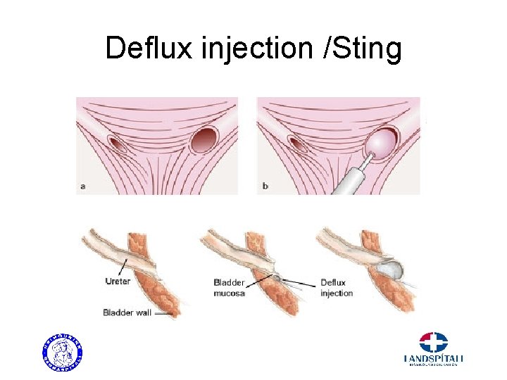 Deflux injection /Sting 