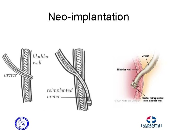 Neo-implantation 