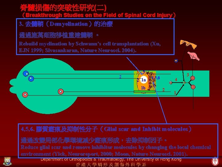 脊髓损傷的突破性研究(二) （Breakthrough Studies on the Field of Spinal Cord Injury ） 3. 去髓鞘（Demyelination）的治療 通過施萬细胞移植重建髓鞘