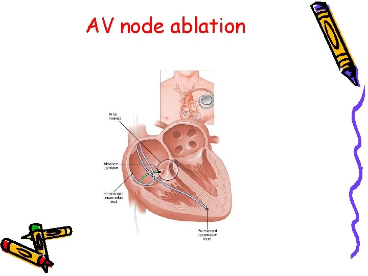 AV node ablation 