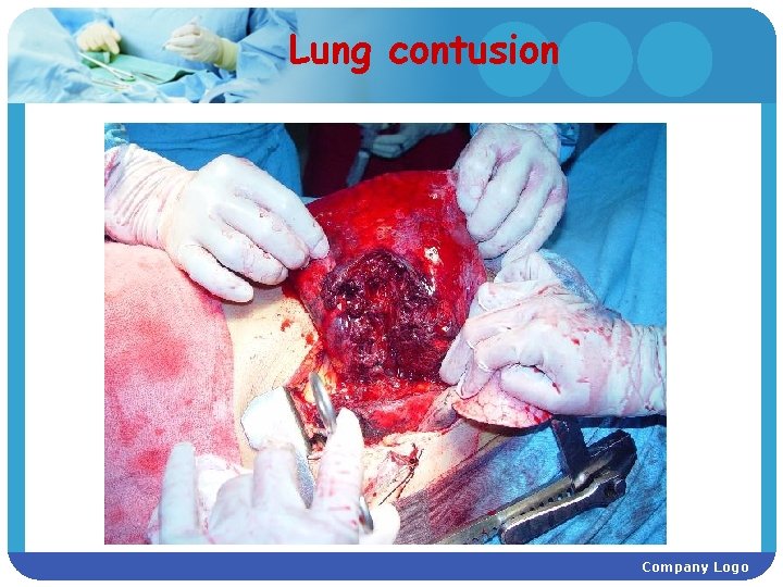 Lung contusion Company Logo 