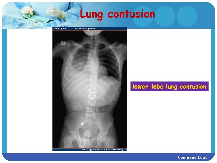 Lung contusion lower-lobe lung contusion Company Logo 