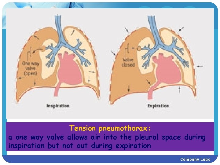 Tension pneumothorax: a one way valve allows air into the pleural space during inspiration