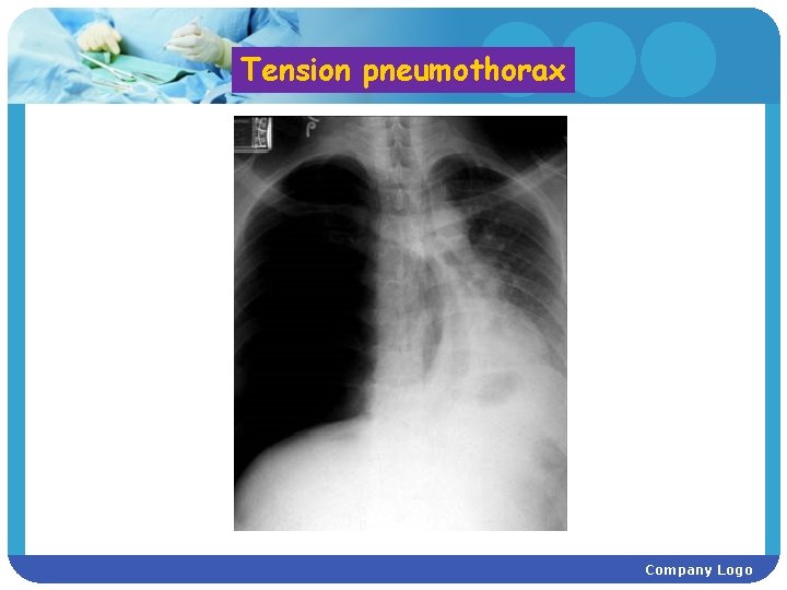 Tension pneumothorax Company Logo 