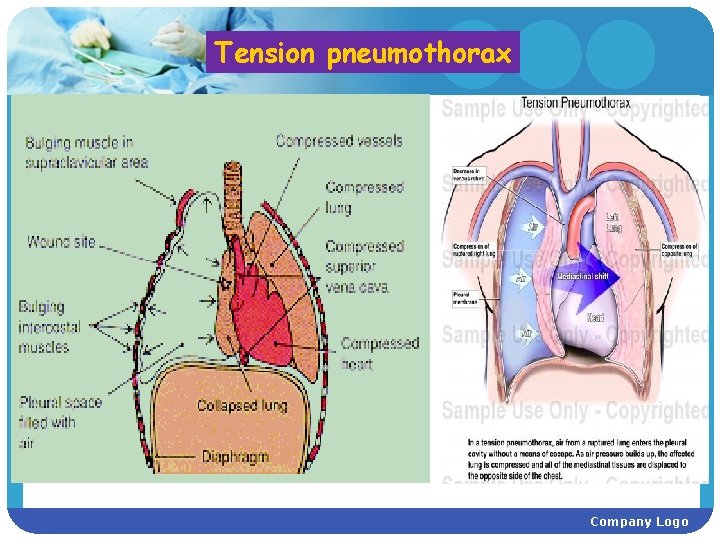 Tension pneumothorax Company Logo 
