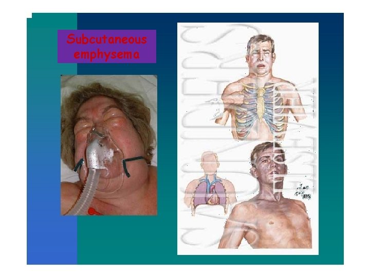 Subcutaneous emphysema 