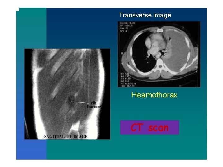 Transverse image Heamothorax CT scan 