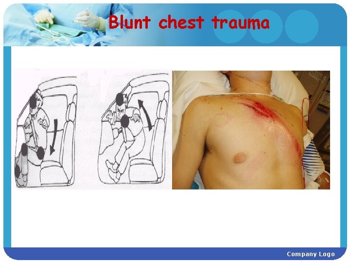 Blunt chest trauma Company Logo 