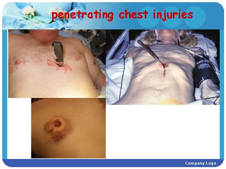 penetrating chest injuries Company Logo 