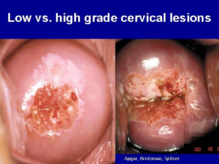 Low vs. high grade cervical lesions Apgar, Brotzman, Spitzer 