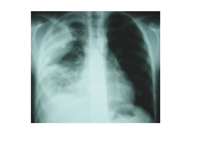 Derrame pleural 