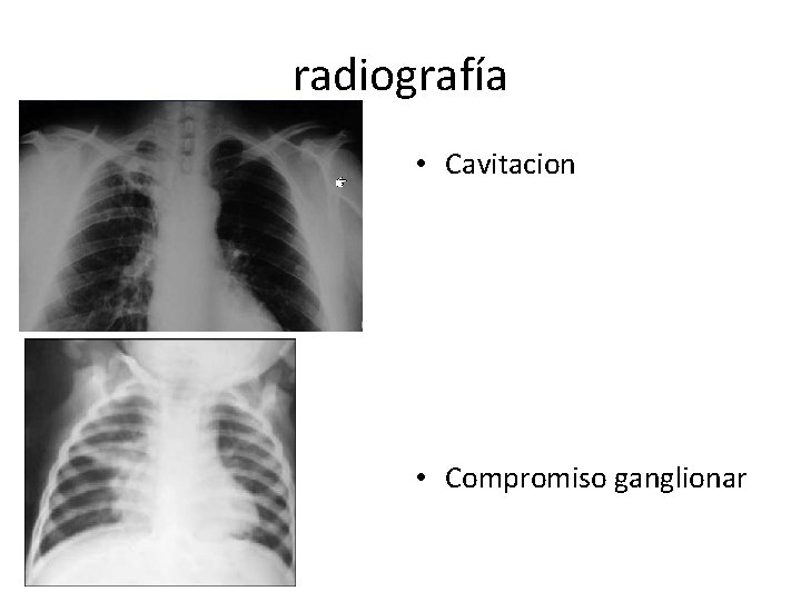 radiografía • Cavitacion • Compromiso ganglionar 