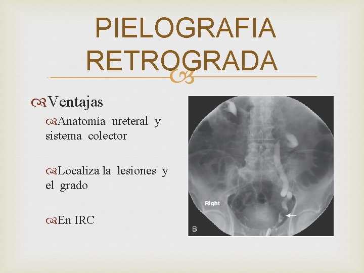 PIELOGRAFIA RETROGRADA Ventajas Anatomía ureteral y sistema colector Localiza la lesiones y el grado