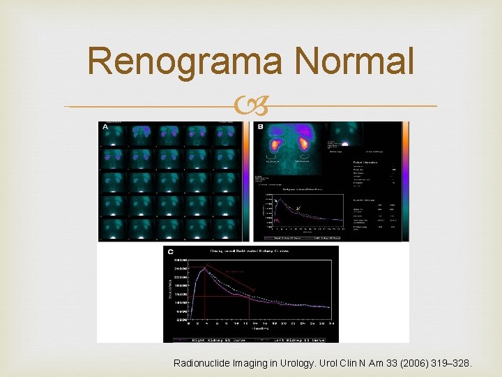 Renograma Normal Radionuclide Imaging in Urology. Urol Clin N Am 33 (2006) 319– 328.