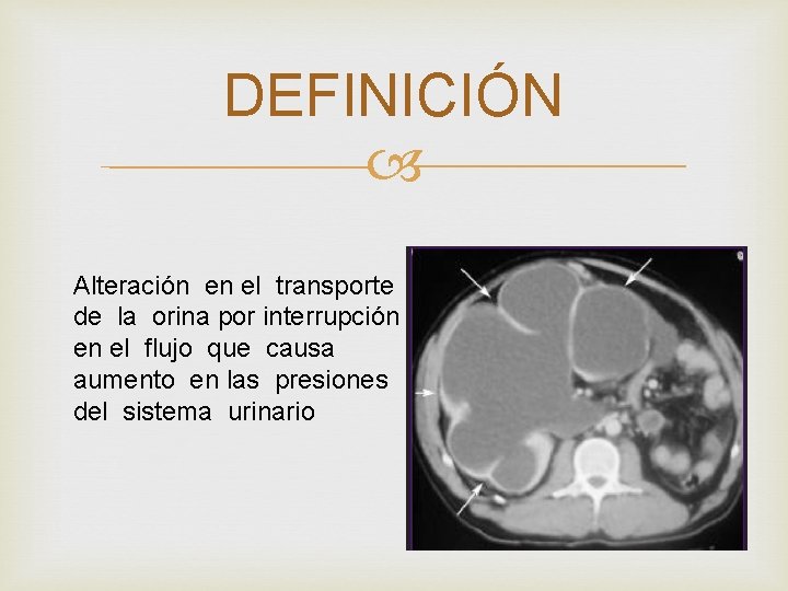 DEFINICIÓN Alteración en el transporte de la orina por interrupción en el flujo que