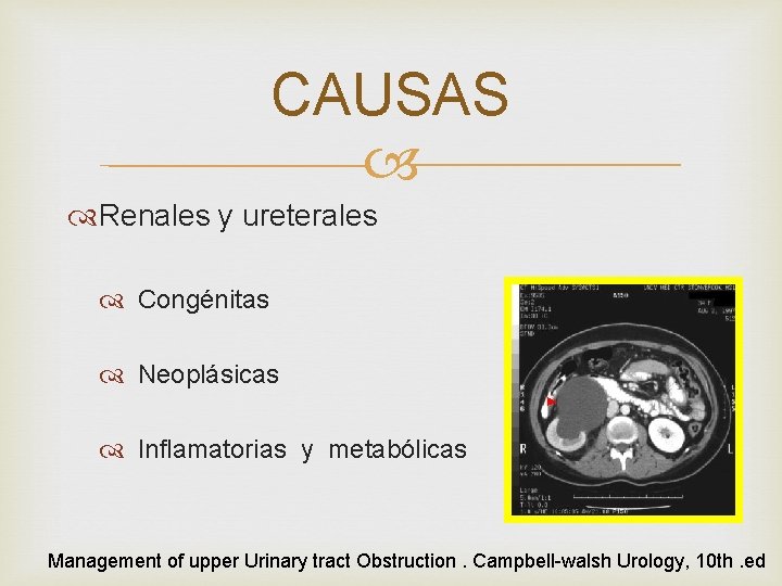 CAUSAS Renales y ureterales Congénitas Neoplásicas Inflamatorias y metabólicas Management of upper Urinary tract