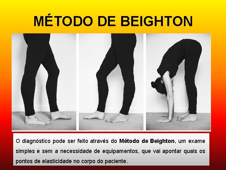 MÉTODO DE BEIGHTON O diagnóstico pode ser feito através do Método de Beighton, um