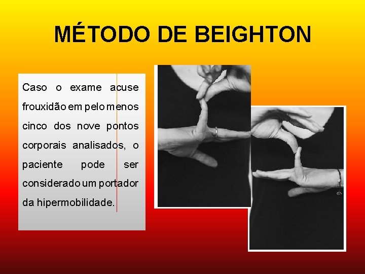 MÉTODO DE BEIGHTON Caso o exame acuse frouxidão em pelo menos cinco dos nove