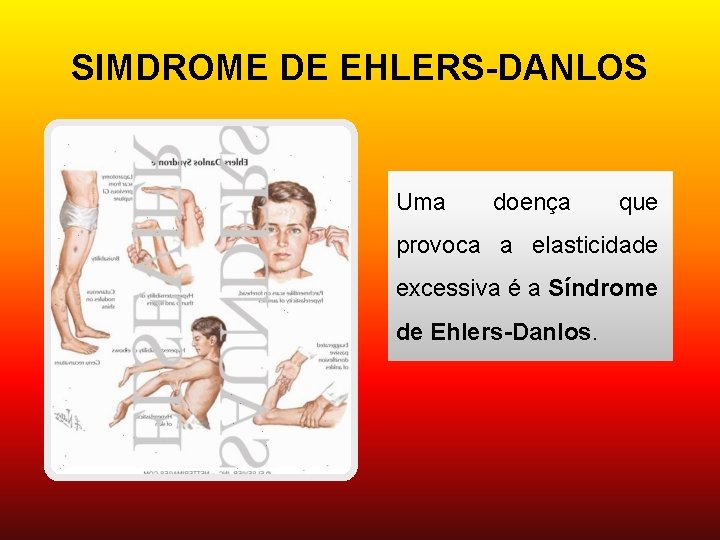 SIMDROME DE EHLERS-DANLOS Uma doença que provoca a elasticidade excessiva é a Síndrome de