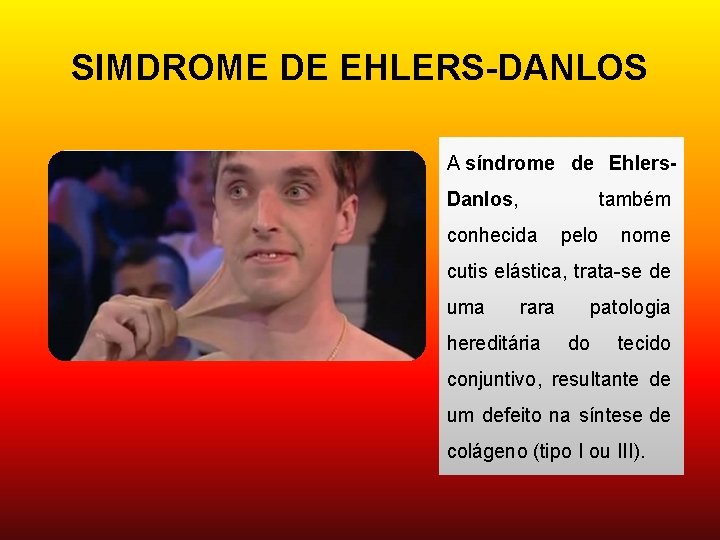 SIMDROME DE EHLERS-DANLOS A síndrome de Ehlers. Danlos, também conhecida pelo nome cutis elástica,
