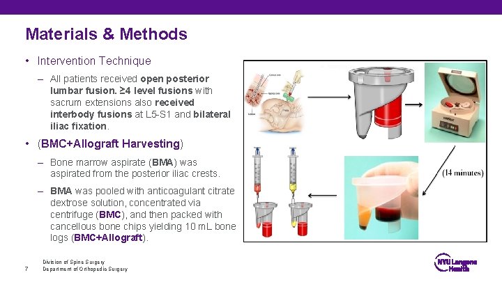 Materials & Methods • Intervention Technique – All patients received open posterior lumbar fusion.