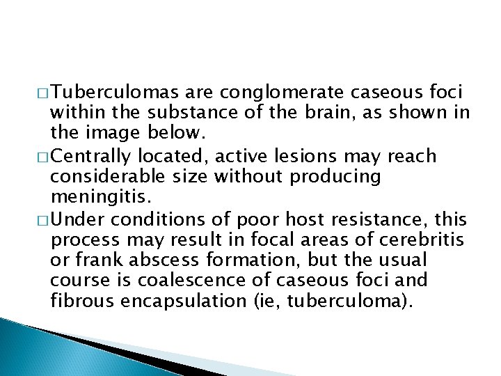 � Tuberculomas are conglomerate caseous foci within the substance of the brain, as shown