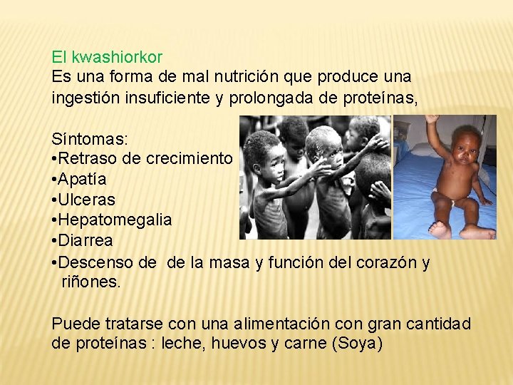 El kwashiorkor Es una forma de mal nutrición que produce una ingestión insuficiente y