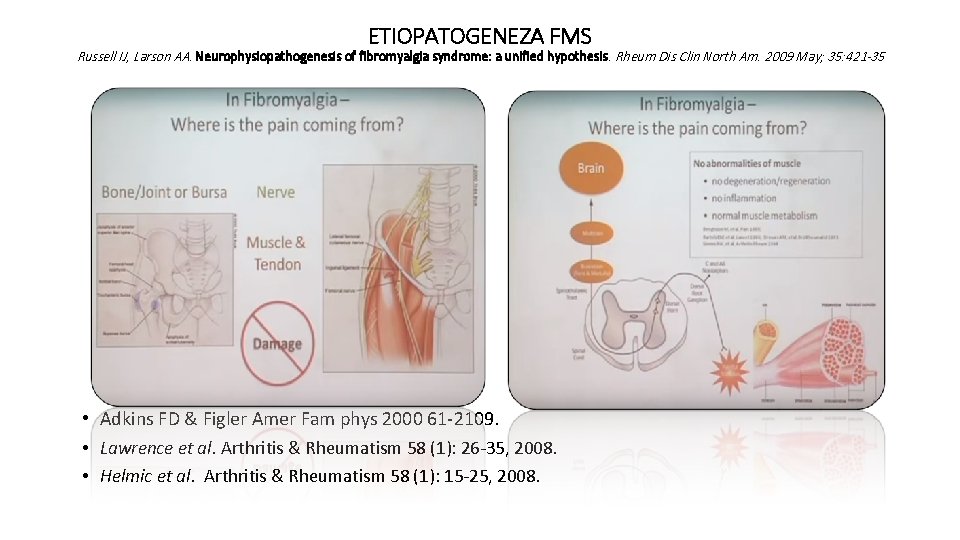  ETIOPATOGENEZA FMS Russell IJ, Larson AA. Neurophysiopathogenesis of fibromyalgia syndrome: a unified hypothesis.
