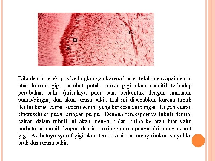 Bila dentin terekspos ke lingkungan karena karies telah mencapai dentin atau karena gigi tersebut Bila dentin terekspos ke lingkungan karena karies telah mencapai dentin atau karena gigi tersebut