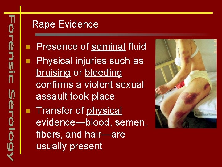Rape Evidence n n n Presence of seminal fluid Physical injuries such as bruising