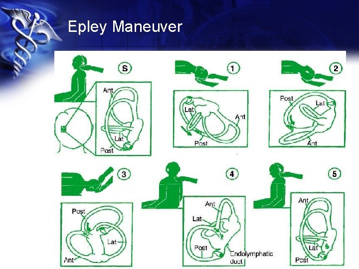 Epley Maneuver 