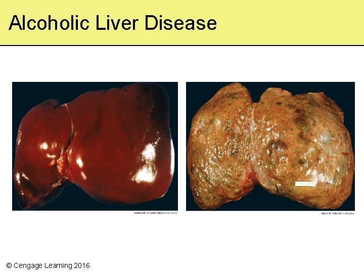 Alcoholic Liver Disease © Cengage Learning 2016 