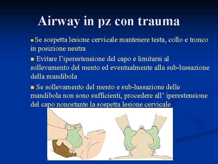 Airway in pz con trauma Se sospetta lesione cervicale mantenere testa, collo e tronco
