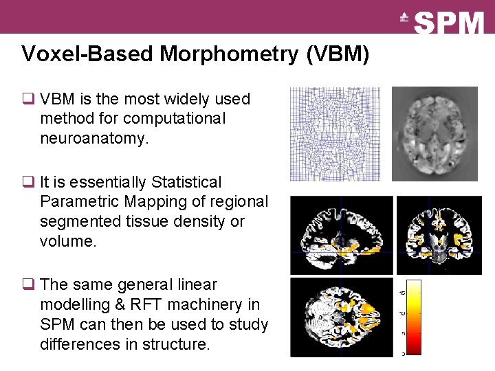 Voxel-Based Morphometry (VBM) q VBM is the most widely used method for computational neuroanatomy.