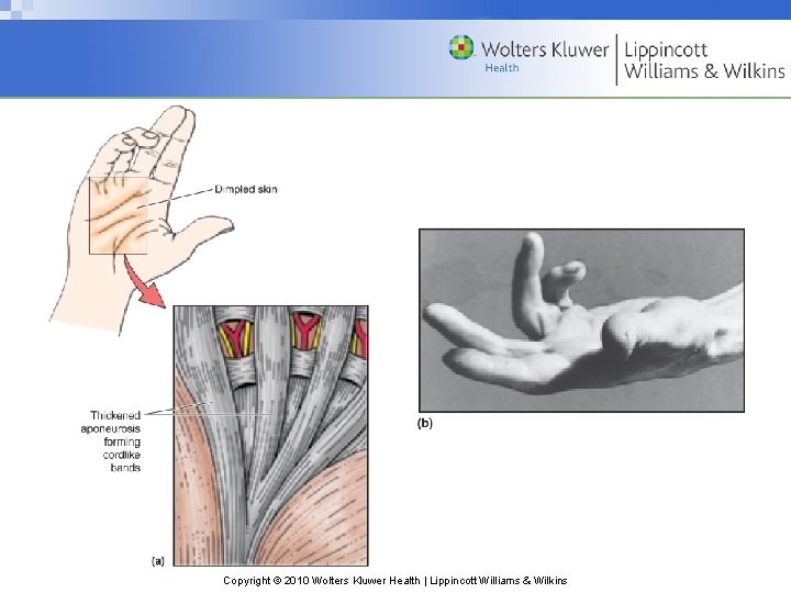 Copyright © 2010 Wolters Kluwer Health | Lippincott Williams & Wilkins 