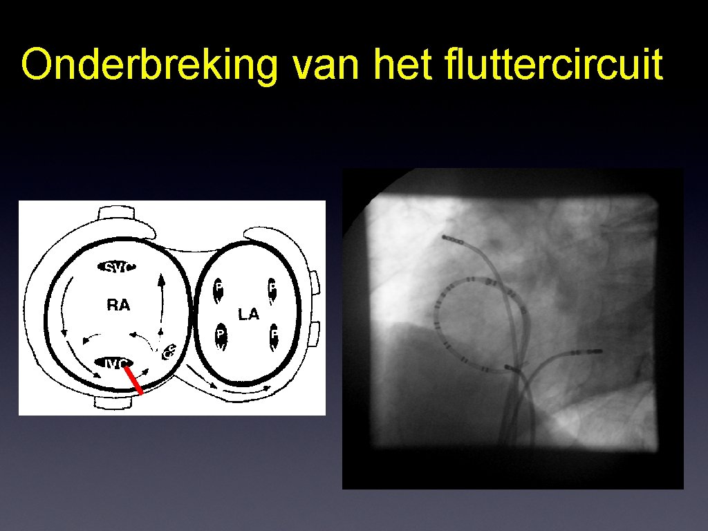 Onderbreking van het fluttercircuit 