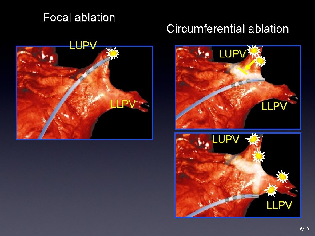 Focal ablation LUPV Circumferential ablation LUPV LLPV 6/13 