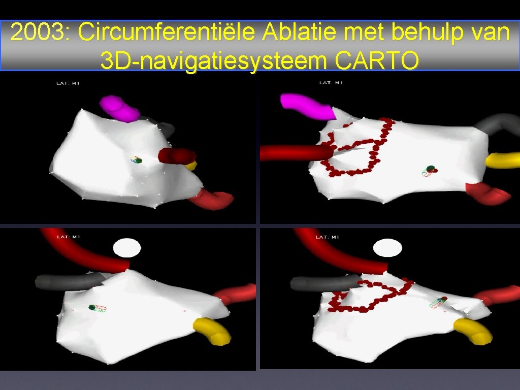 2003: Circumferentiële Ablatie met behulp van 3 D-navigatiesysteem CARTO 