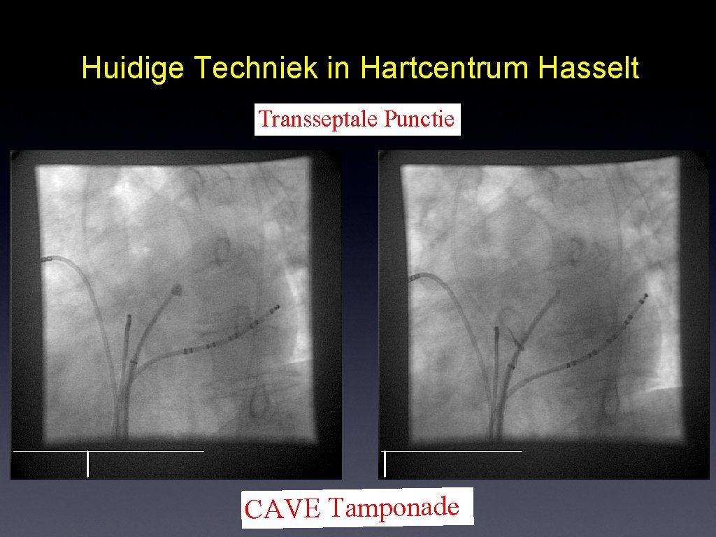 Huidige Techniek in Hartcentrum Hasselt Transseptale Punctie CAVE Tamponade 