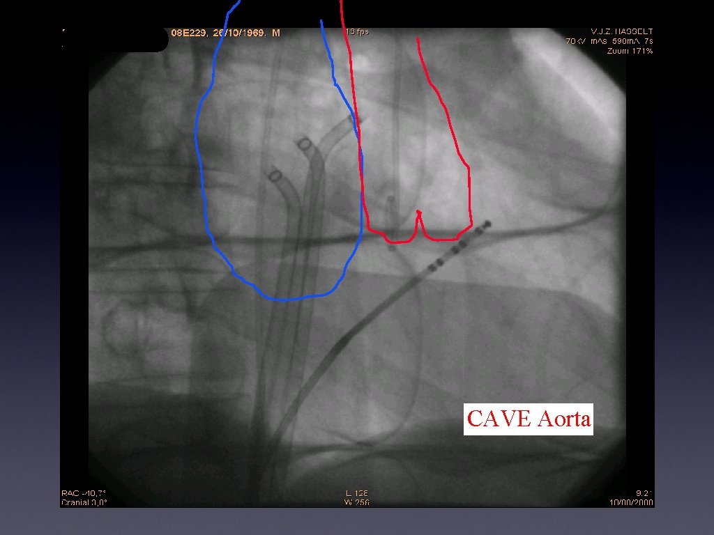 CAVE Aorta 