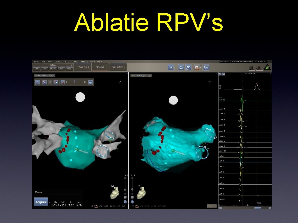 Ablatie RPV’s 