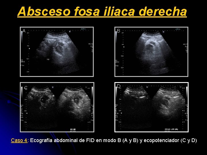 Absceso fosa iliaca derecha A C B D Caso 4: Ecografía abdominal de FID