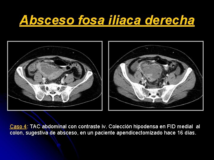 Absceso fosa iliaca derecha Caso 4: TAC abdominal contraste iv. Colección hipodensa en FID