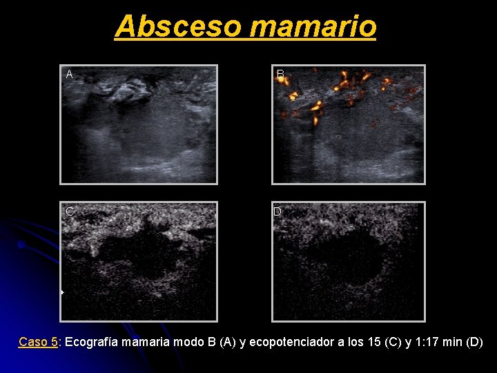 Absceso mamario A B C D Caso 5: Ecografía mamaria modo B (A) y